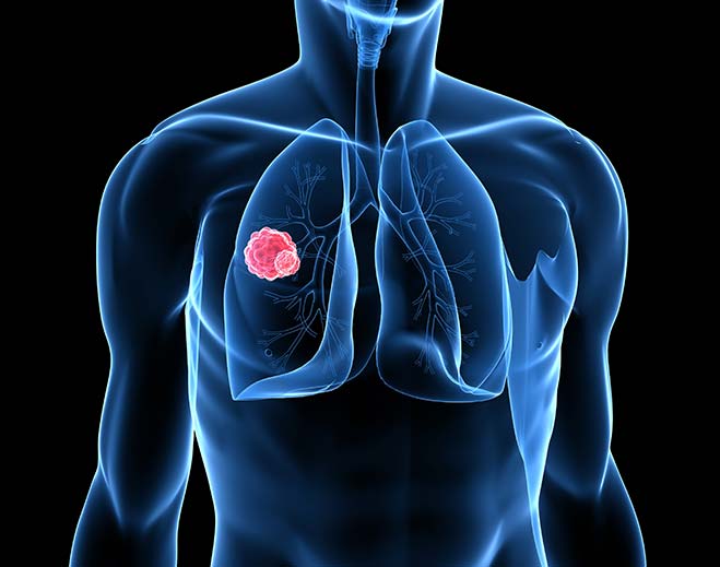 lung-cancer-diagram